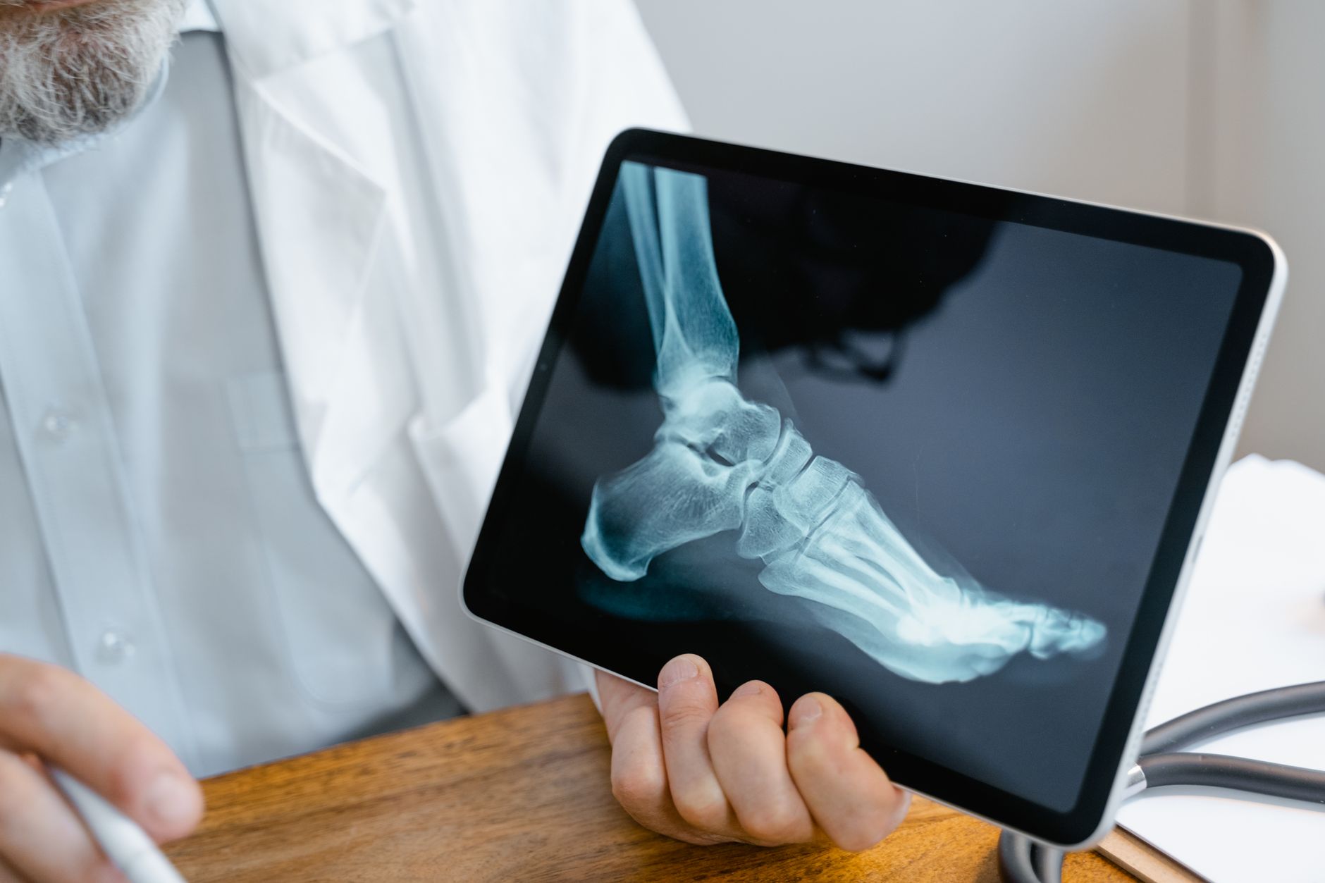Fracture de fatigue au pied : comprendre ce qui se passe vraiment dans l’os — radiographie de pied blessé