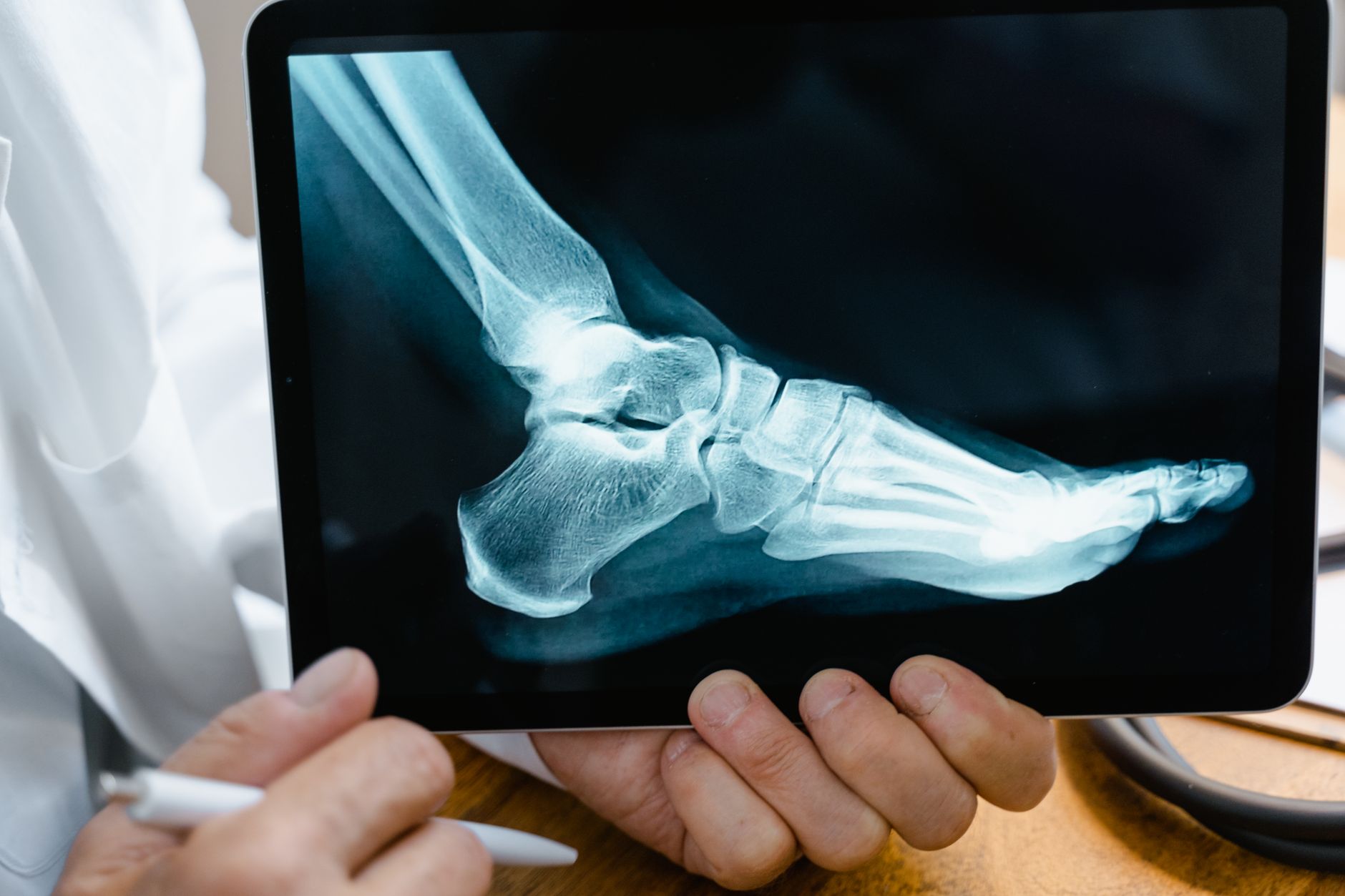 Fracture de fatigue au pied — radiographie de pied blessé